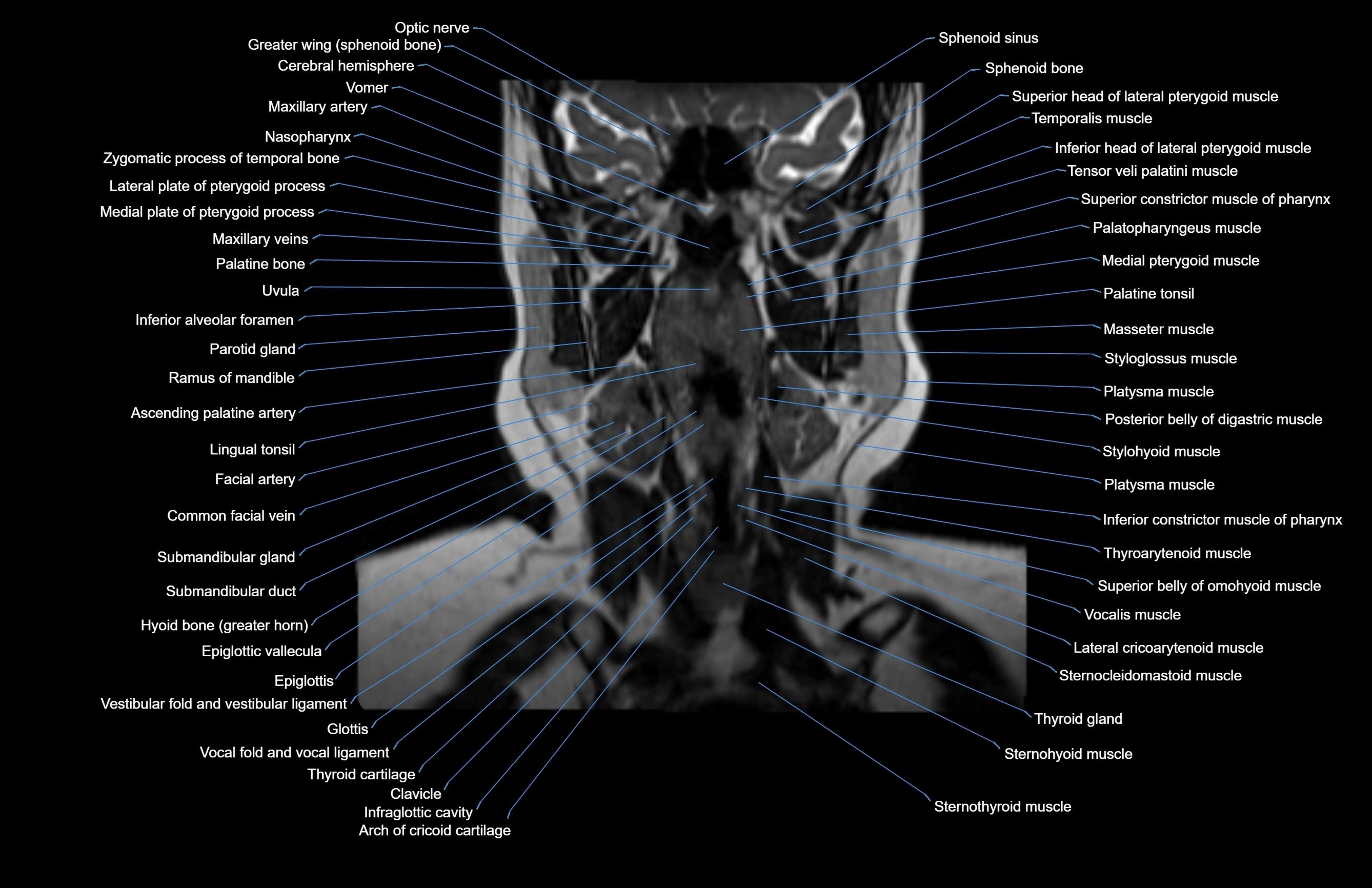 Neck coronal cross sectional MRI anatomy 3T MRI  image-img-00001-00046.webp